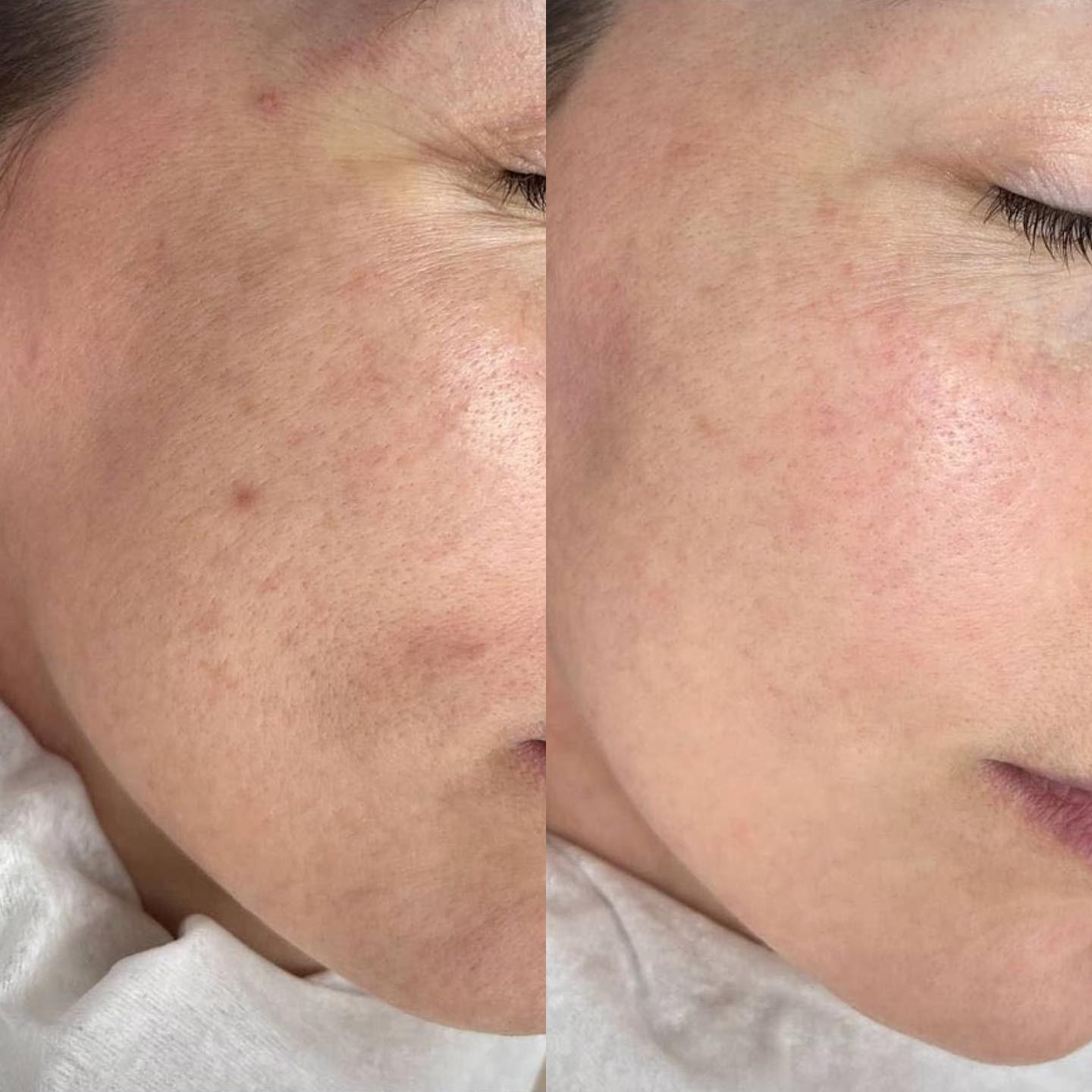Before and after showing pore refinement and smoother cheek texture