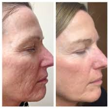 Skin Texture Improvement — Face Profile
