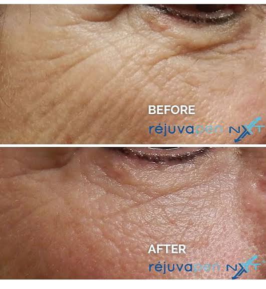 Wrinkle Reduction — Close-Up
