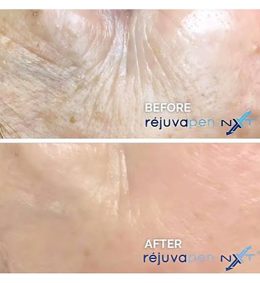 Chest & Décolletage Rejuvenation