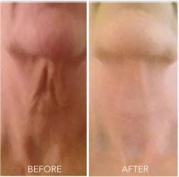Neck Tightening & Texture