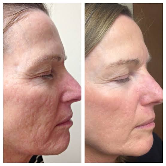 Dramatic Skin Texture Improvement
