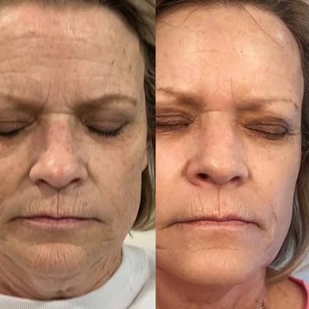 Wrinkle & Fine Line Reduction