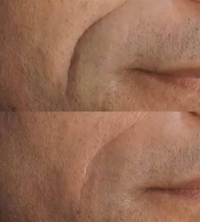 Nasolabial Fold Improvement
