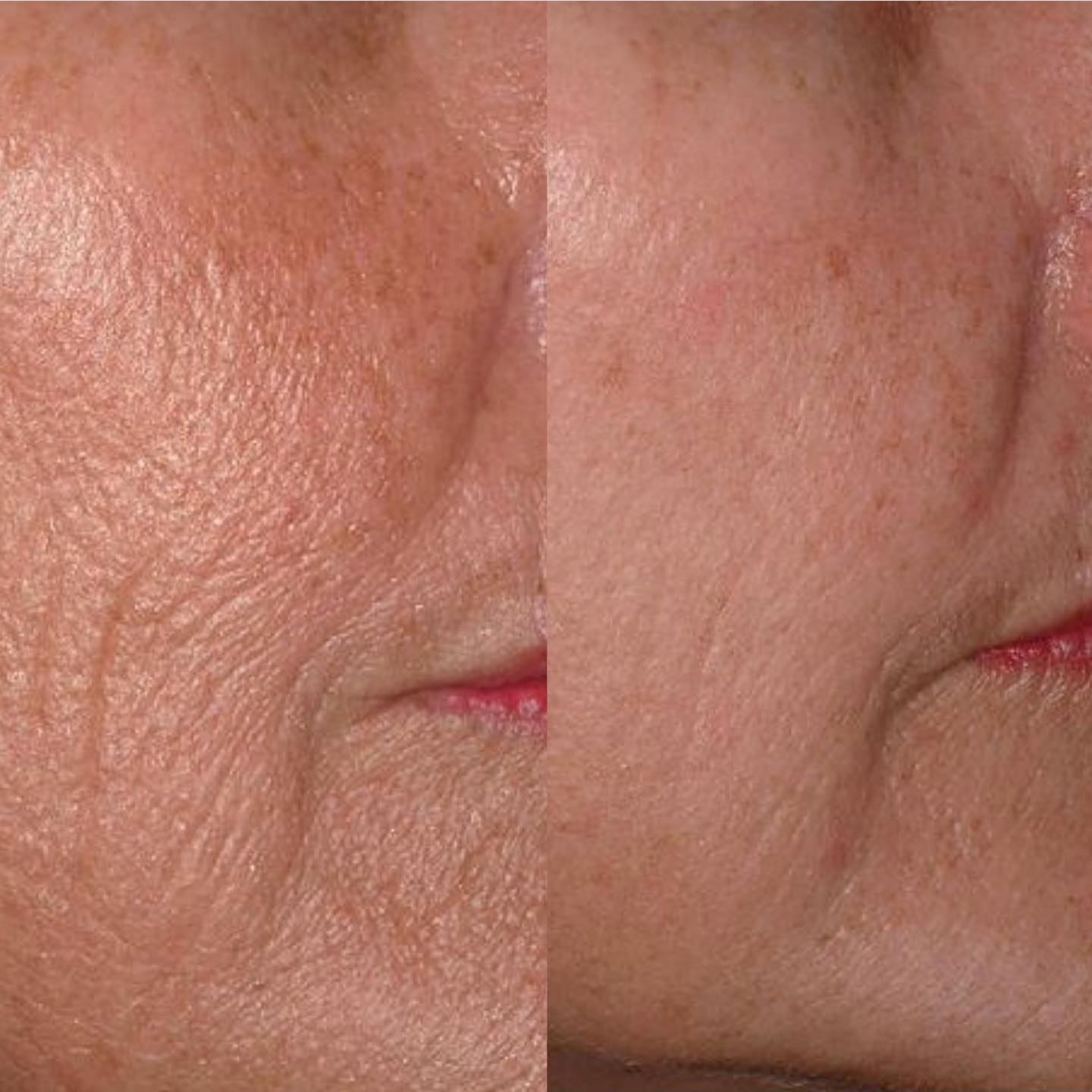 Before and after showing wrinkle reduction around the mouth and nasolabial fold area