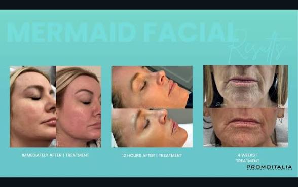 Clinical Results: Immediately After · 12 Hours After · 4 Weeks After 1 Treatment