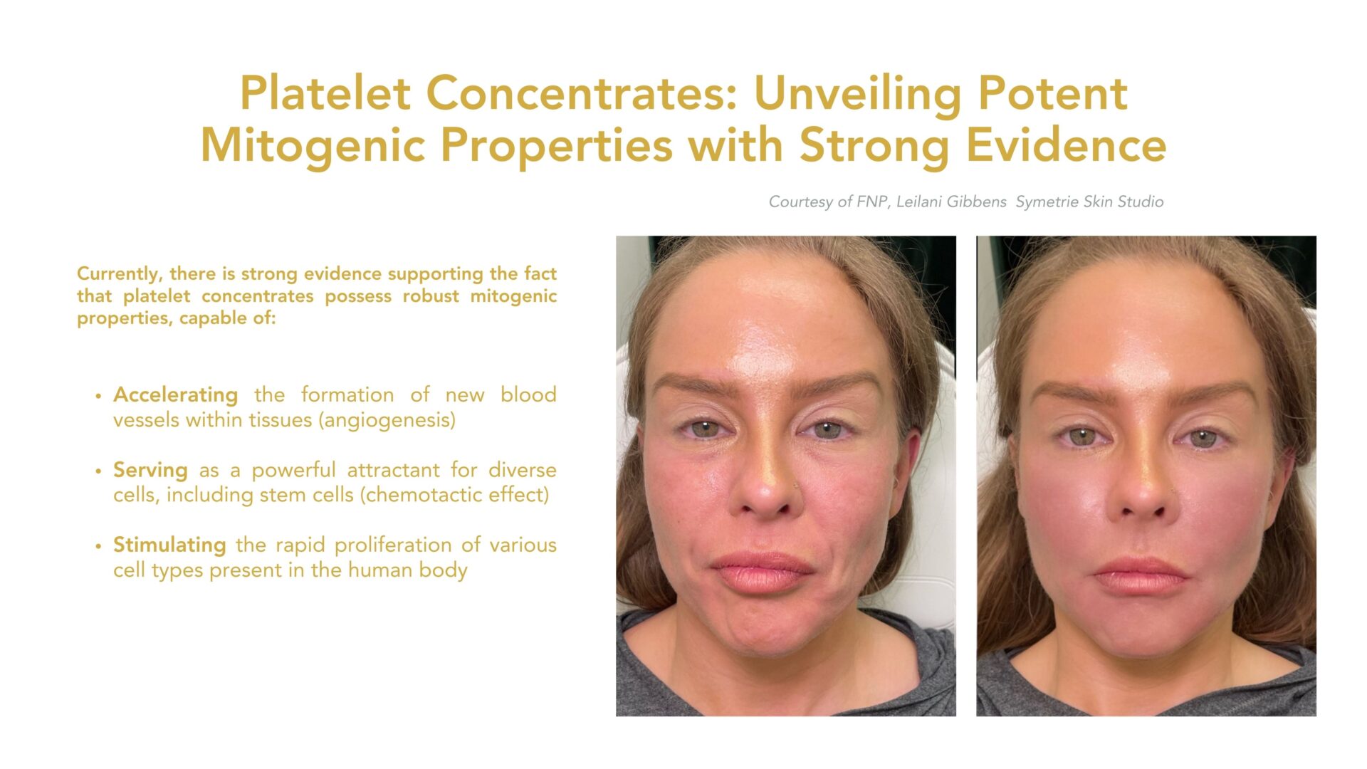 Platelet Concentrate Facial Rejuvenation Study